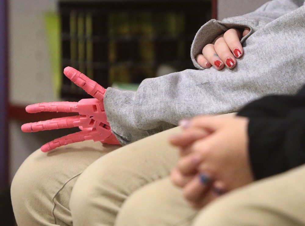 Kids test lower cost and lighter weight prostheses made by 3D printers in new study at Children's Hospital